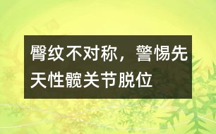 臀紋不對(duì)稱，警惕先天性髖關(guān)節(jié)脫位
